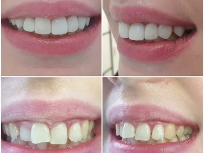 bonding, bonding chorzów, dentysta dziecięcy chorzów, implanty chorzów, licówki kompozytowe chorzów