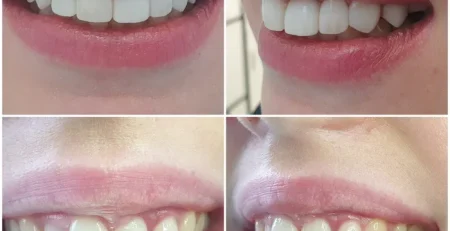 bonding, bonding chorzów, dentysta dziecięcy chorzów, implanty chorzów, licówki kompozytowe chorzów