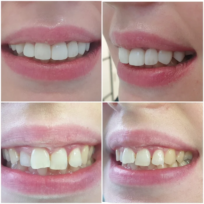 bonding, bonding chorzów, dentysta dziecięcy chorzów, implanty chorzów, licówki kompozytowe chorzów