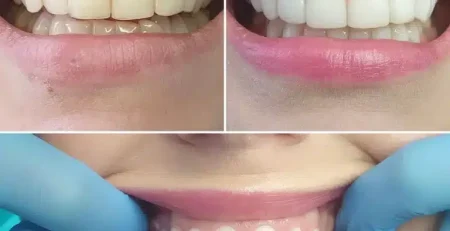 bonding, bonding chorzów, dentysta dziecięcy chorzów, implanty chorzów, licówki kompozytowe chorzów