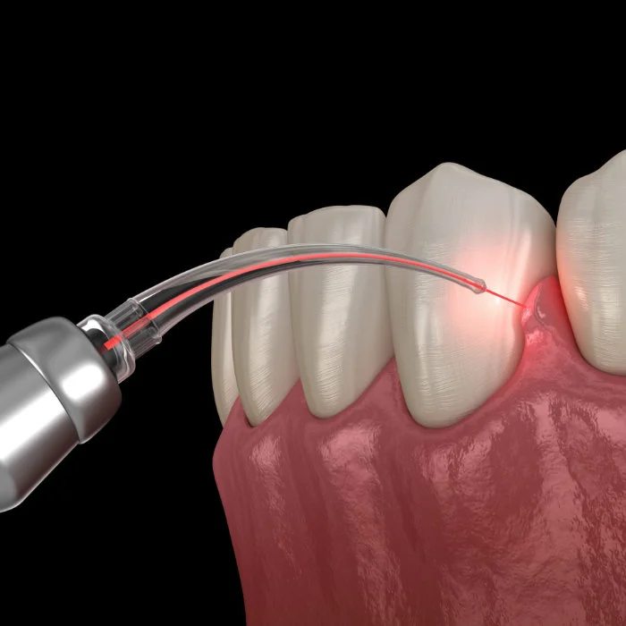 Leczenie chorób dziąseł – Periodontologia